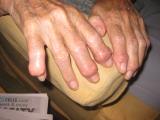 Clinical quiz 1: Granny’s knobbly fingers *updated*