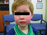 Clinical Quiz: The Rosy Cheeked Child